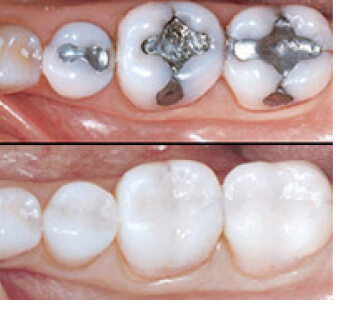 Chipped Teeth repair in London Ontario - London Ontario Dental Clinic