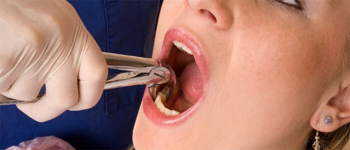 Dental Extractions